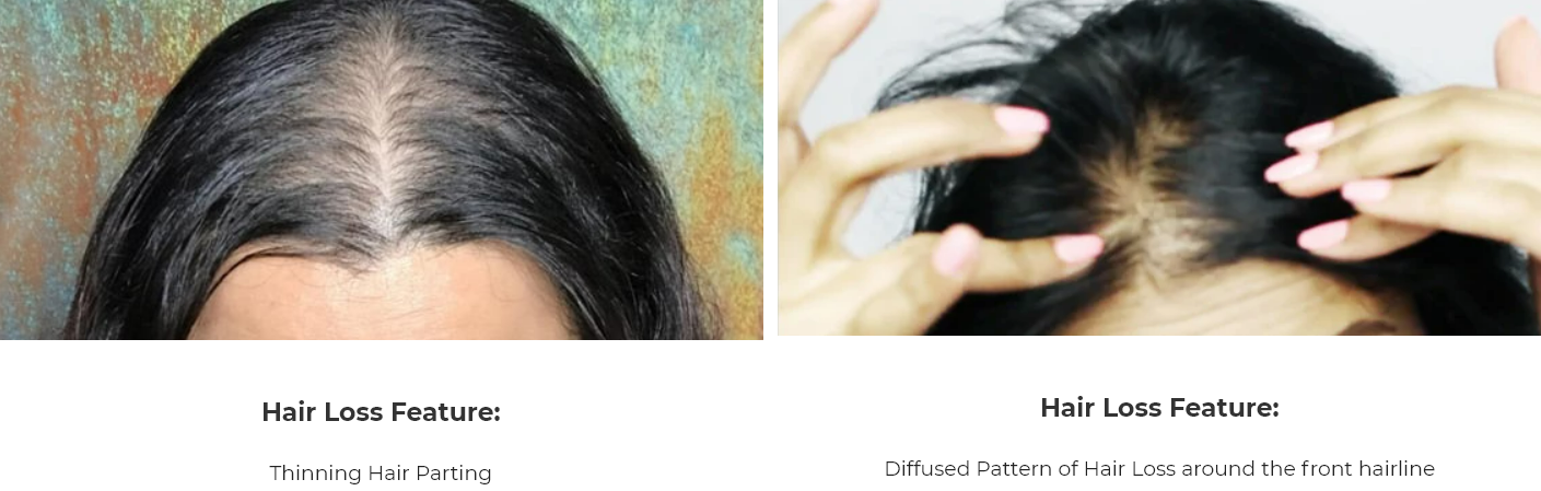 hair-loss-alopecia-sashlabelle-hair-canada
